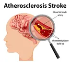 What are the various types of stroke?  Information about hemorrhagic and ischemic stroke as well as transient ischemic attack or mini stroke.