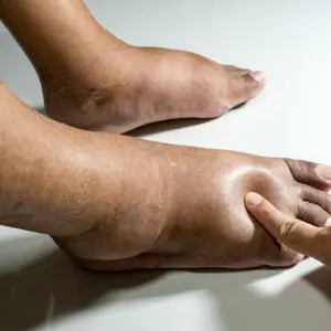 foot swelling after stroke