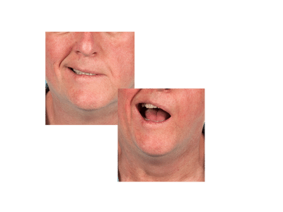Facial Droop Bells Palsy