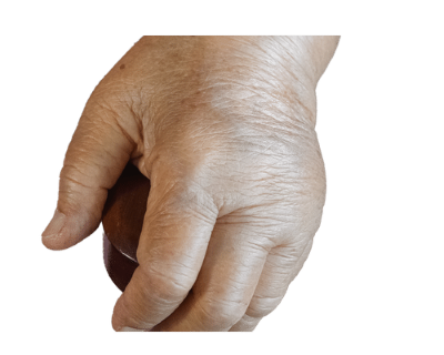 Hand with Edema