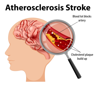 Stroke Caused by Atherosclerosis