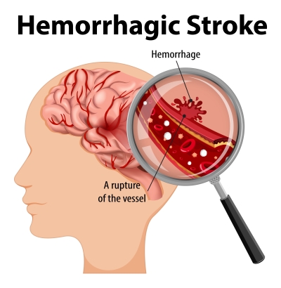 Hemorrhagic Stroke