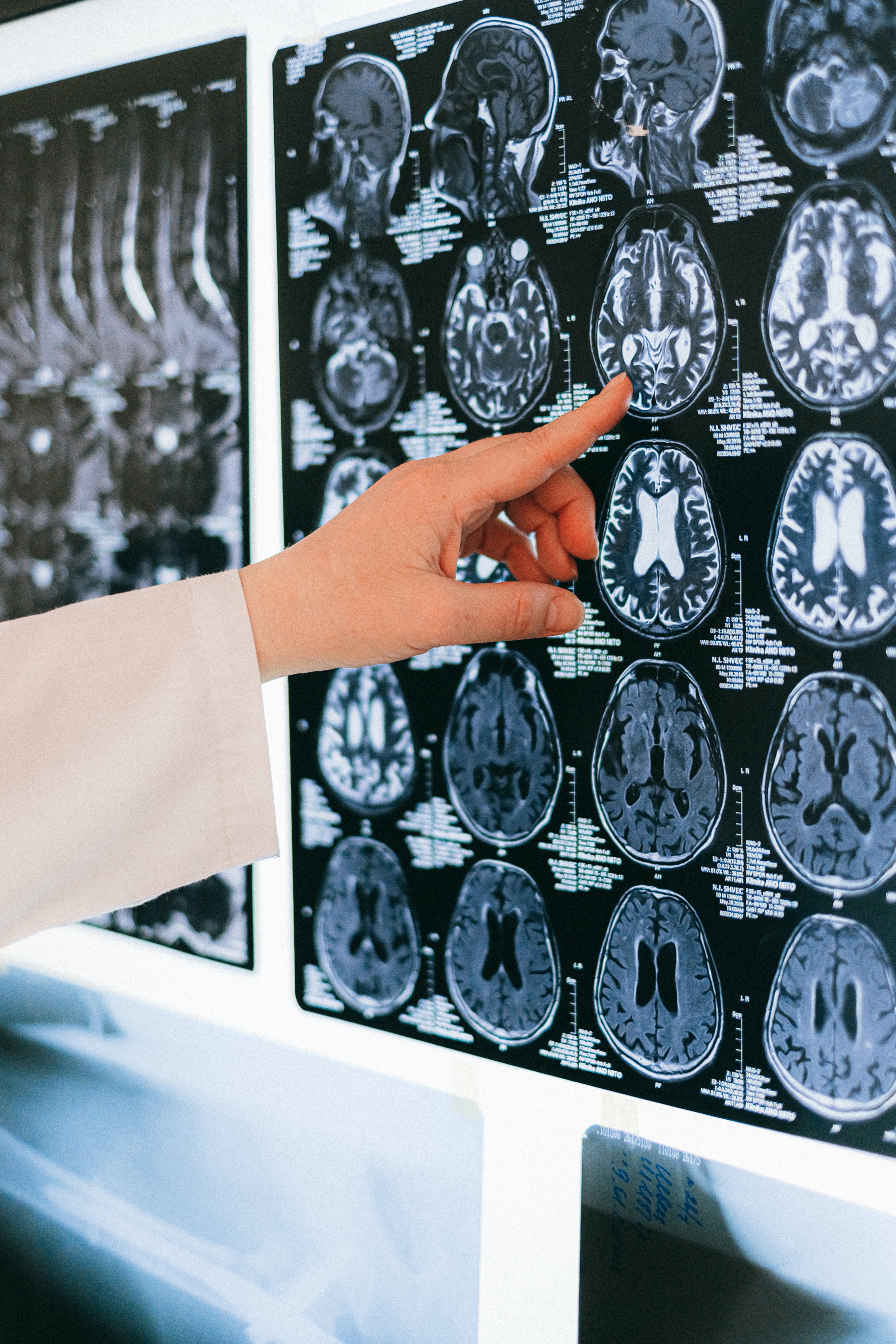 Brain Imaging Stroke