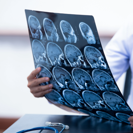 Stroke and Brain Damage Imaging