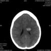 My hemorrhage in deep parietal lobe, above thalamus