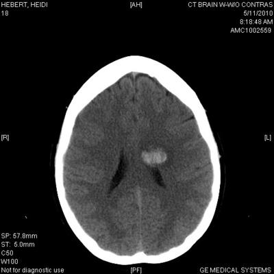 My hemorrhage in deep parietal lobe, above thalamus